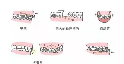 牙齿正畸中骨钉有什么作用