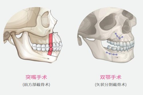 在广州做正颌手术是种什么体验？看着两位小姐姐的正颌经历