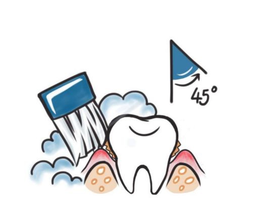 戴牙套如何清理自己的牙齿？get这几招牙齿一直白白净净