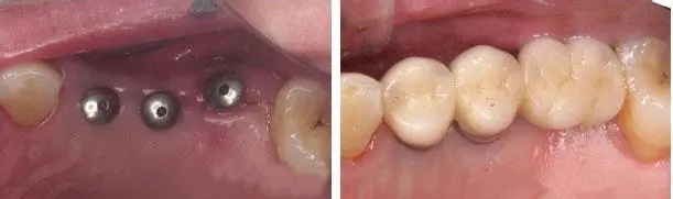 缺失6颗牙齿镶牙还是种牙