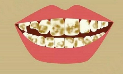 长期抽烟牙齿变得又黑又黄，这3个“美白”方法对你有用