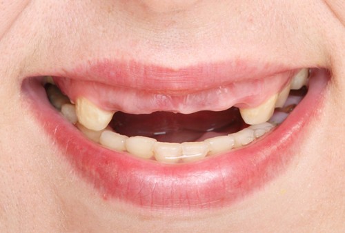 牙齿缺失除了种牙还有什么方法？看目前三种假牙方式哪种比较好