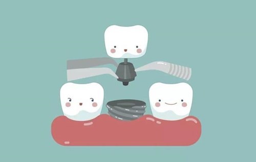 老年人缺牙怎么办？老了解是装假牙好还是种植牙好？