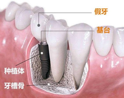 当天拔牙当天种牙可以吗？广州哪家口腔医院有这种即刻种植技术？