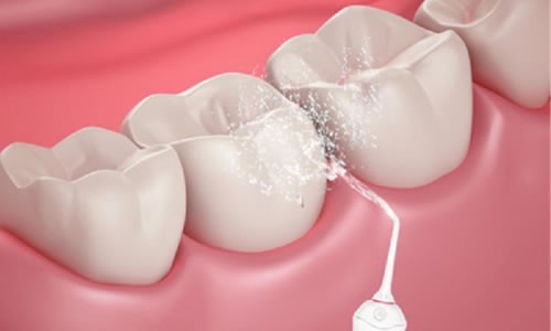 水牙线为什么冲不干净？水牙线能代替牙刷吗