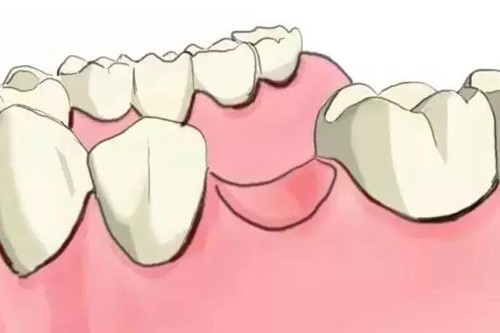 牙齿缺失多久不能种植了？我后槽牙缺失6年了还能种牙吗？