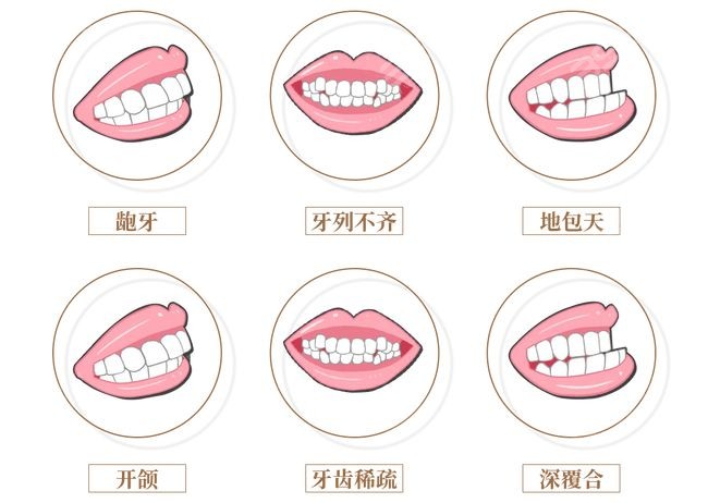 牙齿矫正的类型