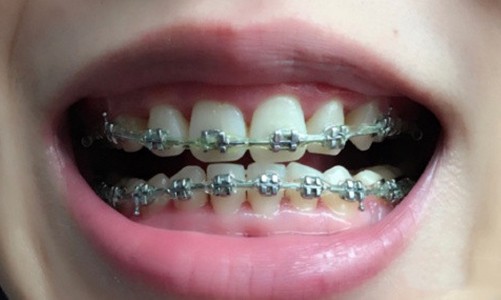 矫正牙齿的价格一般多少钱？全新牙套价目表2021