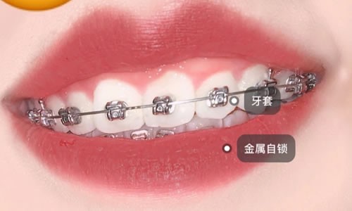 2021戴牙套需要多少钱？参考深圳2021牙套价目表