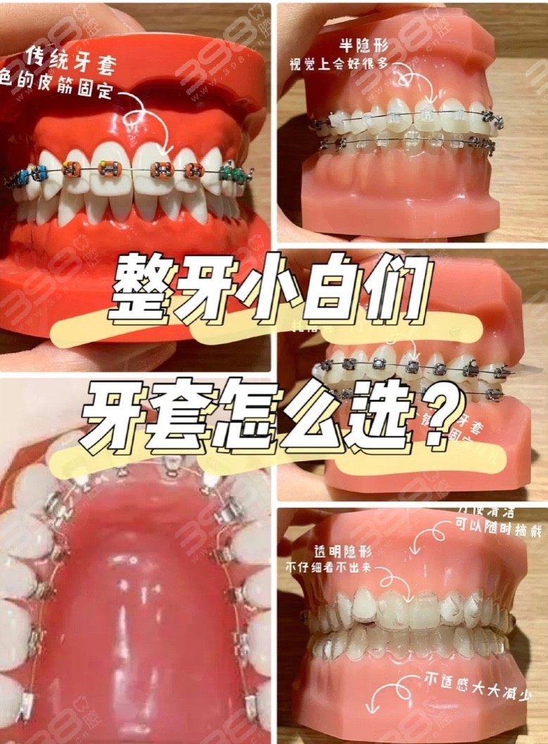 牙齿矫正的类型