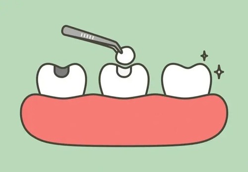 补牙有哪几种材料？补完牙后酸痛是怎么回事