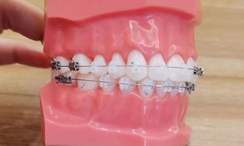 杭州牙齿矫正大概多少钱？新版2021牙套价目表上线