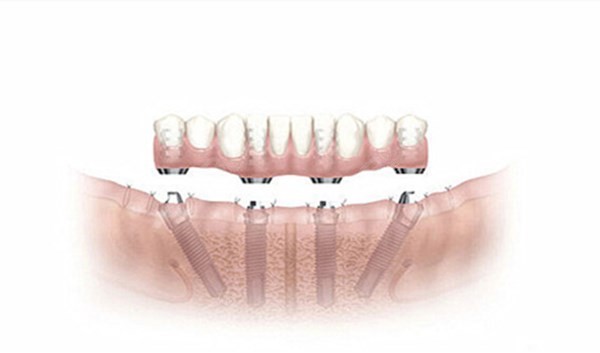 种植牙半固定和全固定的区别是什么