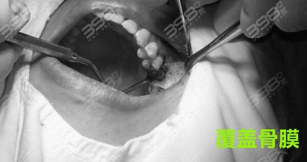 种植牙手术过程-覆盖骨膜