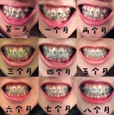 矫正牙齿真实过程每个月的变化图