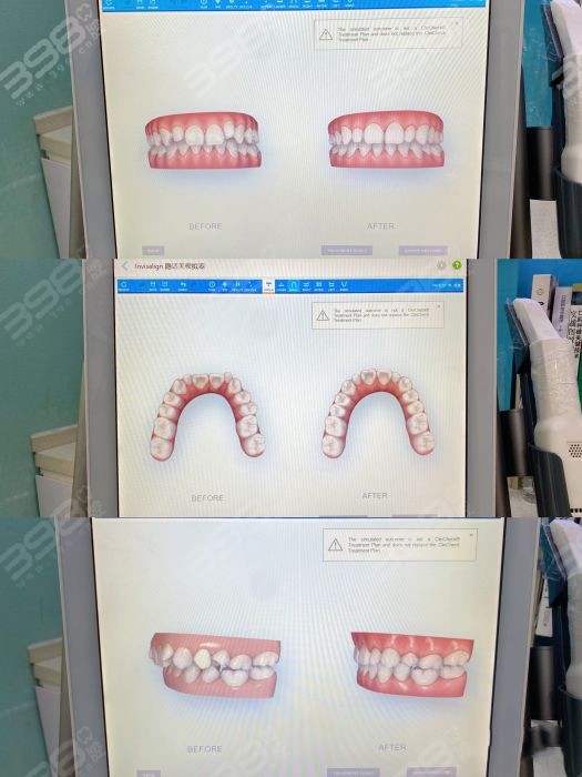 2021年牙齿矫正价格表公示：含12-40岁各种牙套所需费用