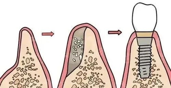 哪种人适合不植骨种牙?一文让你秒懂植骨粉和种植牙的关系