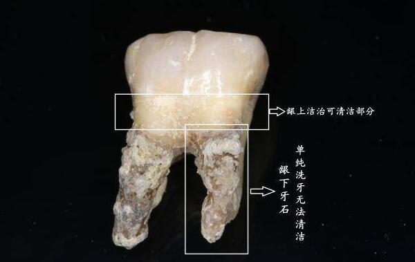 牙结石长到牙龈里了该怎么处理？为什么会长在牙龈里？