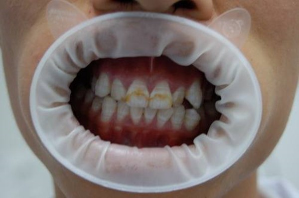 超声波洗牙能把牙齿洗白吗？有烟渍的黄牙可以洗白吗？