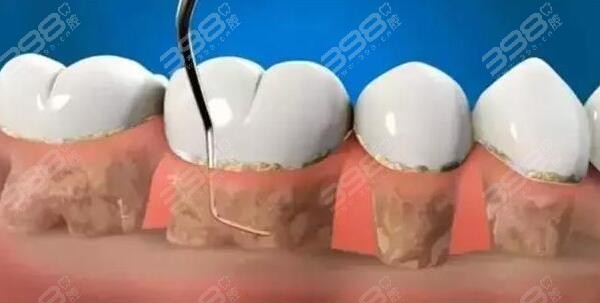 牙结石为什么会长在牙龈里