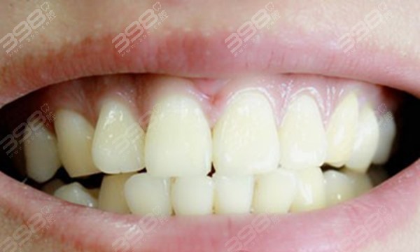 超声波洗牙能把有烟渍的黄牙可以洗白吗