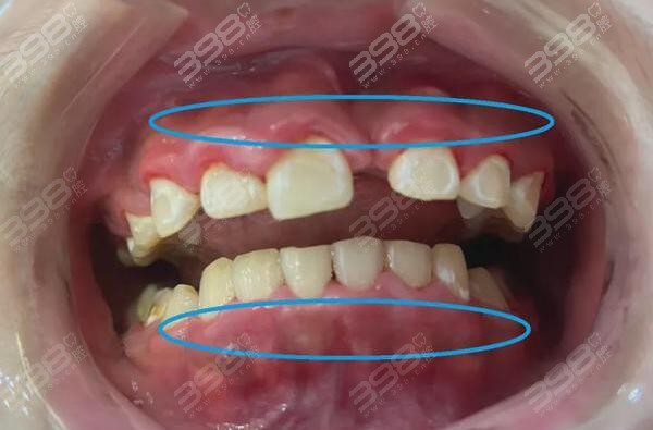 牙结石长到牙龈里了该怎么处理？为什么会长在牙龈里？