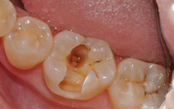 口腔医院补牙要多少钱一颗？补牙后一般能维持几年？