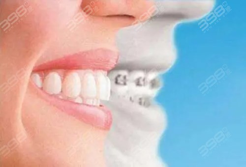 牙齿矫正常见误区