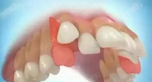 牙齿矫正常见误区