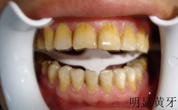 我的牙齿太黄了怎么变白？牙齿美白哪种方法好？