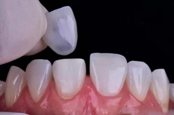 深入了解瓷贴面对牙齿伤害大吗？瓷贴面牙齿多少钱一颗？