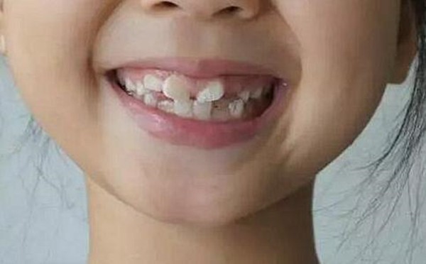 小孩子牙齿矫正较好的年龄段是什么时候？多长时间能矫正好？