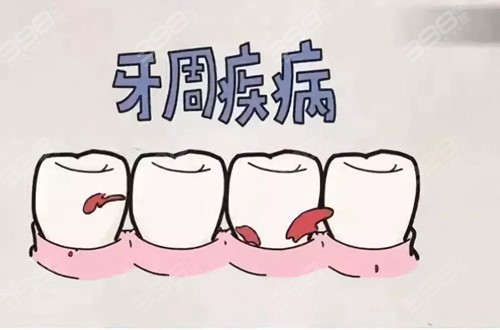 牙周疾病