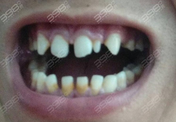 牙齿稀疏