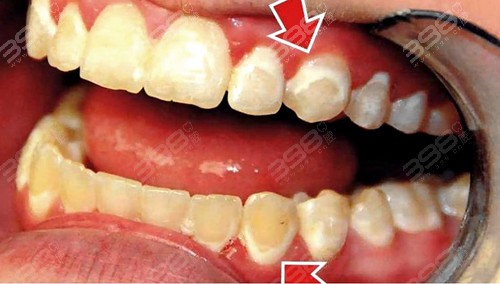 正畸期间牙齿矿化怎么引起的