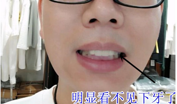 上牙盖着下牙这正常吗？上牙完全覆盖下牙有什么后果？