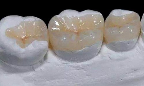 补牙300和500一颗有什么区别？补牙选哪种材料比较好？