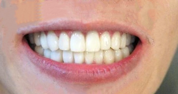 脸型不好看是牙齿不整齐导致的吗？牙齿矫正能瘦全脸吗？