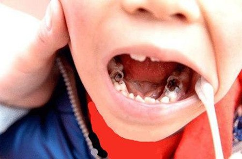 儿童蛀牙需要补牙吗？8岁儿童牙被蛀空了怎么办？