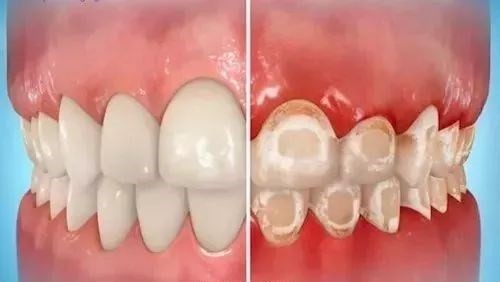 矫正后为什么牙齿发黄，怎么才能有效的清洁牙齿？
