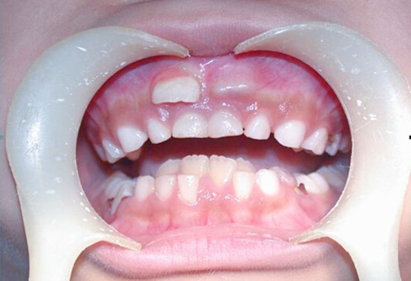 这颗多出来的牙齿叫多生牙，你真的不准备拔牙吗？