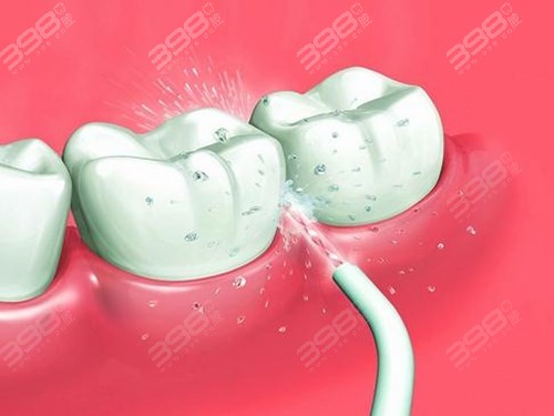 牙齿矫正中怎么才能有效的清洁牙齿