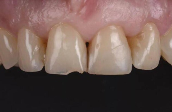 为什么不建议树脂补门牙缝?树脂补前门牙成功图片挺不错啊!