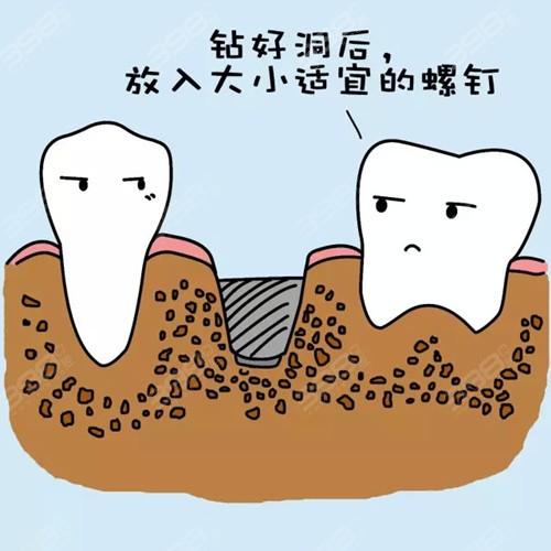 愈合基台在牙齿种植中的作用