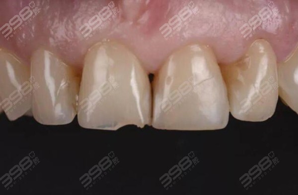 为什么不建议树脂补门牙缝?树脂补前门牙成功图片挺不错啊!