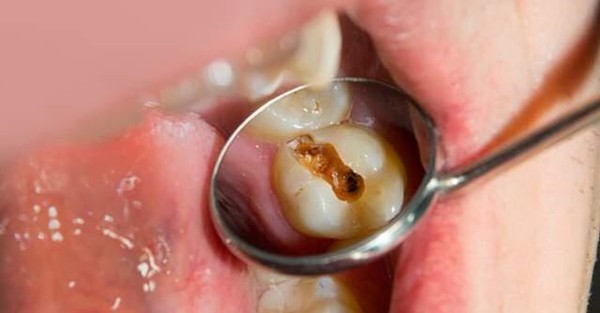 牙齿痛有个洞疼痛难忍怎么办，有什么办法能根治？