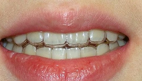 隐形牙套和钢牙套哪个好？适美乐隐形矫正有哪些优势？