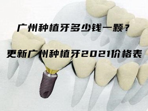 广州种植牙多少钱一颗？更新广州种植牙2021价格表