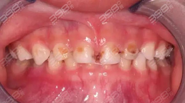 学前儿童牙齿卫生保健-告别小黄牙