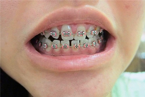 13岁儿童牙齿矫正多少钱？儿童牙齿矫正会有危害吗？